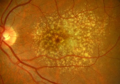 Age-Related Macular Degeneration Image