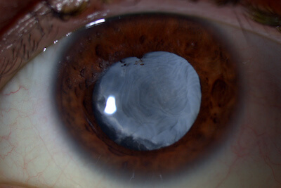 Cataract in the eye