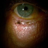 Tick on lower eyelid