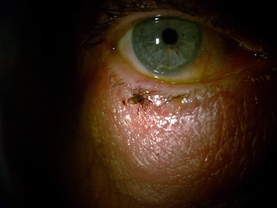 Tick on lower eyelid