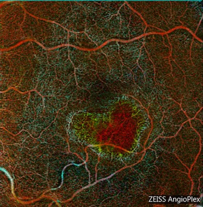 Heart shaped cnv on OCTA