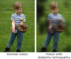 Diabetic Retinopathy