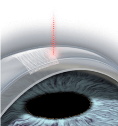 LASIK Portland Maine | What to Expect | EMG