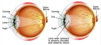 Cataract eye diagram