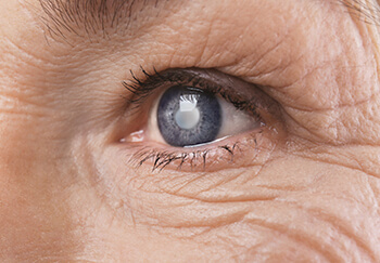 Close up of an eye with cataracts