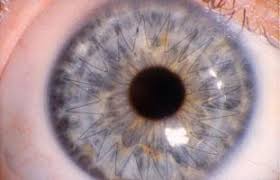 Closeup of an Eye That Has Had a Cornea Transplant