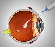 Diabetic Retinopathy with vegj