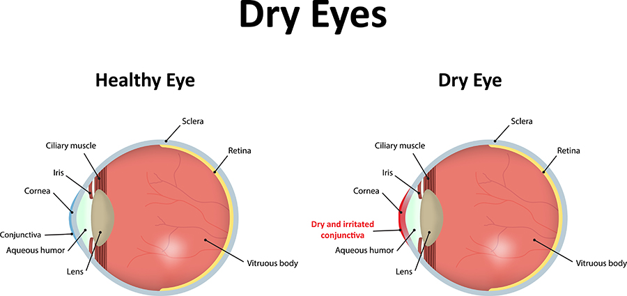 Dry Eyes Diagram