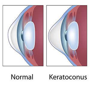 Chart Showing a Healthy Eye Compared to One With Keratoconus