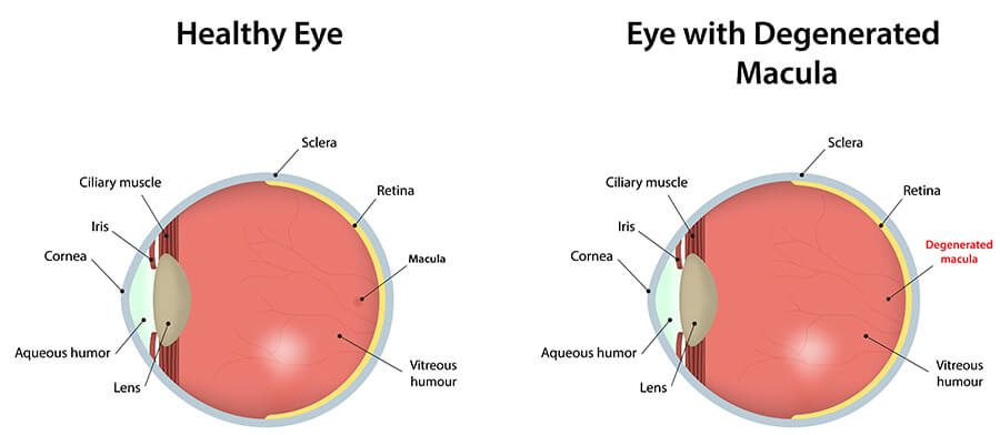 Macular Degeneration Diagram