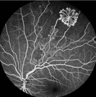 Fluorescein Angiography