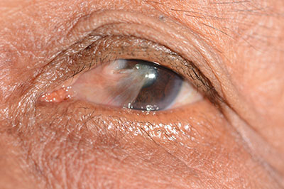 Pterygium Example