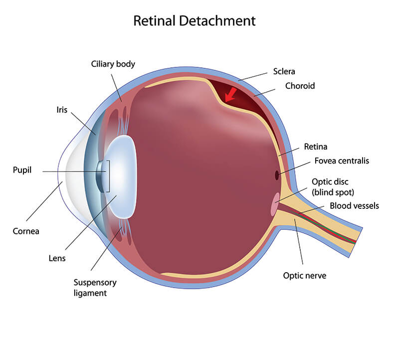 Chart Illustrating a Retinal Detachment