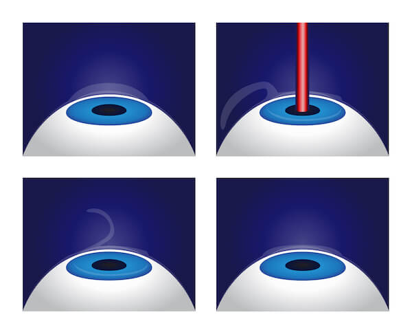 LASIK surgery diagram